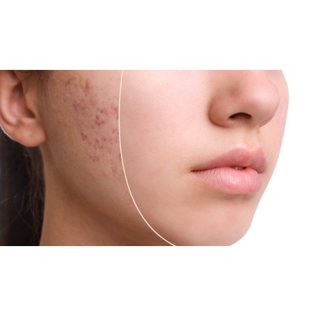 Acne and impure skin | Buy medicines from the online pharmacy